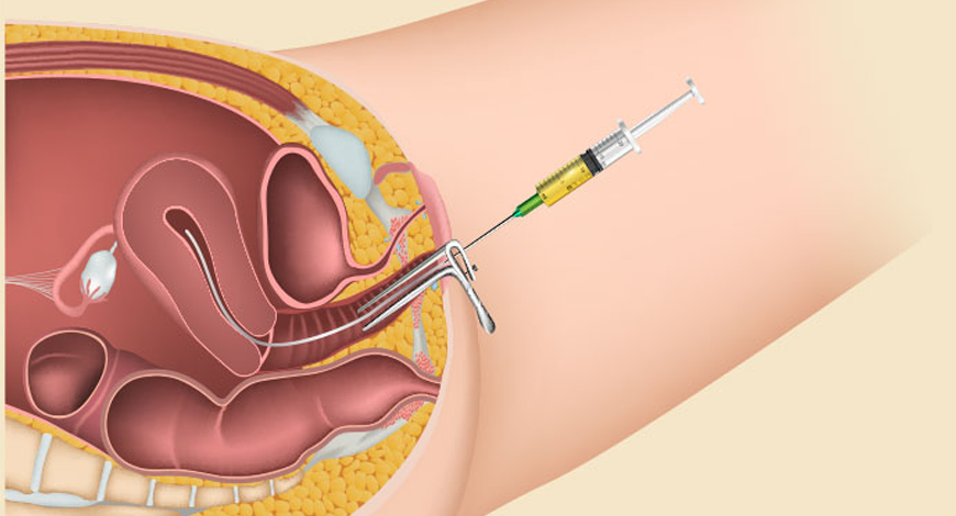Fresh or Frozen Embryo Transfer Process Step By Step for IVF